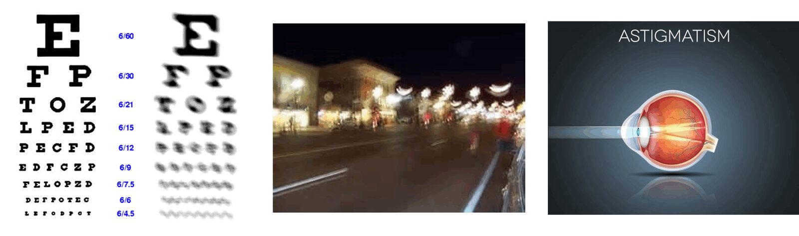 photo - astigmatism